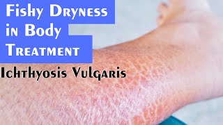 Ichthyosis Vulgaris Fishy Dryness Explained by Dr Rohit Goel [upl. by Moth568]