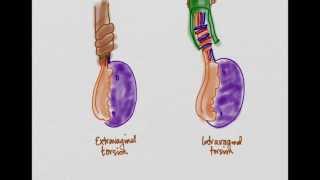 Testicular Torsion [upl. by Eronaele]