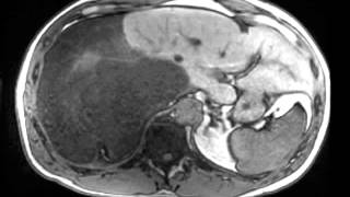 Dedifferentiated Retroperitoneal Liposarcoma [upl. by Onia]