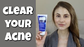 HOW TO CLEAR YOUR SKIN WITH BENZOYL PEROXIDE DR DRAY [upl. by Anertal748]