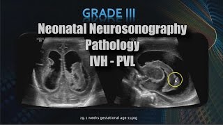 Neonatal Neurosonography  Pathology  IVH  PVL [upl. by Ettesus]