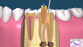 ENDODONCIA MANUAL POSTE COMPO CORONA [upl. by Oregolac270]