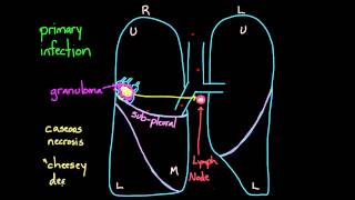 Primary and Secondary TB [upl. by Melita]