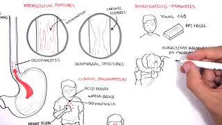 GORD GERD Gastro Oesophageal Reflux Disease  Overview pathophysiology treatment [upl. by Alvita133]