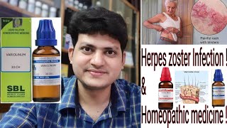 Herpes Zoster  Homeopathic Medicine for Herpes Zoster  Explain [upl. by Hutson]