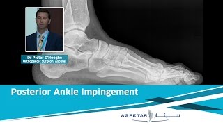 Posterior Ankle Impingement  Dr Pieter D’Hooghe Aspetar [upl. by Shari]