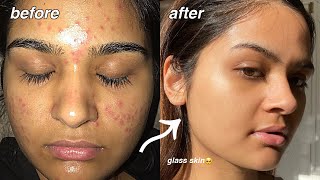 how i cleared my acne FOR GOOD something finally worked [upl. by Nylynnej]