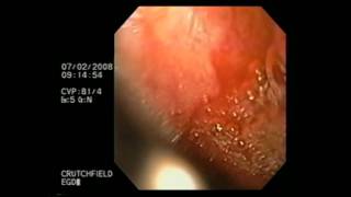 Esophagogastroduodenoscopy [upl. by Earaj93]