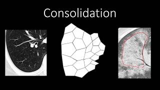 Chest Radiology  Patterns  Airspace [upl. by Eiroc685]