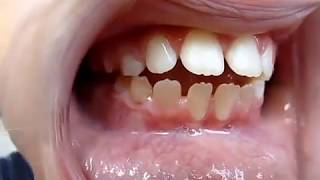 Tongue Thrust Video Myofunctional Therapist [upl. by Teresina613]