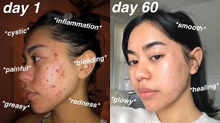 I CLEARED MY ACNE 60 days using Differin Gel Adapalene 01  pictures [upl. by Ahsa]