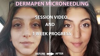 Dermapen Microneedling Before And After  Process  1 Week Amazing Results [upl. by Zeculon608]