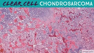 Clear Cell Chondrosarcoma [upl. by Ynots]