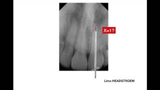 Pulpectomia e Odontometria [upl. by Placia]