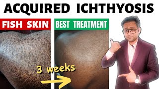 Acquired ichthyosis  Fish skin  Treatment  Hindi [upl. by Neerac715]