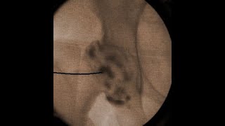 IntraArticular Hip Injection Using Anatomic Surface Landmarks [upl. by Laresa]