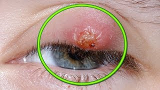 Eye Cysts  Chalazion Treatment and Causes [upl. by Abert902]