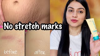 How to Remove Stretch Marks  How to Remove Scars  Stretch Marks Removal Cream  Nidhi Chaudhary [upl. by Tur]