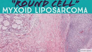 What are Sarcomas  Pathology mini tutorial [upl. by Ellenid43]