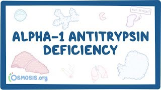 Alpha1 Antitrypsin Deficiency  causes symptoms diagnosis treatment pathology [upl. by Rma407]