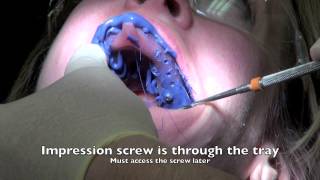 Dental Implant  Impression and Insertion of crown [upl. by Rehtae]