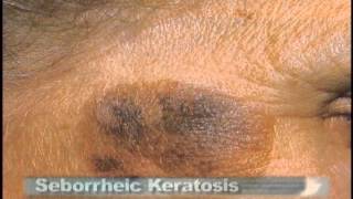 Common Skin Lesions [upl. by Phare]