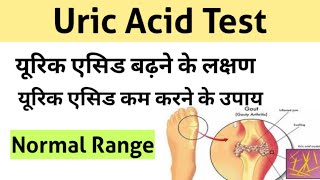 Uric Acid Test in Hindi  uric acid treatment  uric acid symptoms [upl. by Hump]