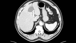 Esophageal leiomyoma distal esophagus  CT [upl. by Nylatsirhc]