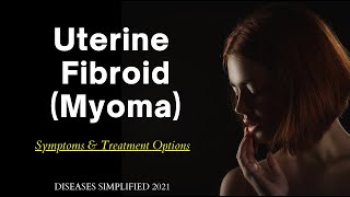 Fibroid Myoma Symptoms amp Treatment Options [upl. by Murial181]