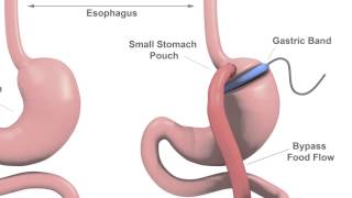 Acid Reflux GERD  Gastric Sleeve Surgery  Questions and Answers [upl. by Sardella850]