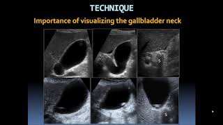 Basic Gallbladder [upl. by Karame]