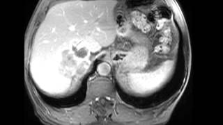 Retroperitoneal Liposarcoma [upl. by Neiman]