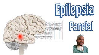 Crise Focal Epilepsia [upl. by Airotnes]