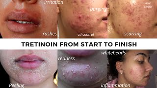 TRETINOIN BEFORE AND AFTER  FULL TRETINOIN EXPERIENCE my journey from start to end Adult Acne [upl. by Itsuj]