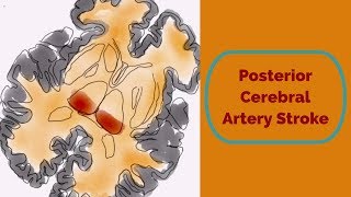 Posterior Cerebral Artery Stroke [upl. by Introk]