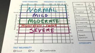 How to Read Your Audiogram [upl. by Eunice]