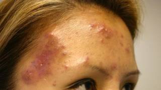 The Acne Practice severe case 5 [upl. by Ymiaj310]