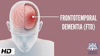 Frontotemporal Dementia Causes Signs and Symptoms Diagnosis and Treatment [upl. by Ilac]