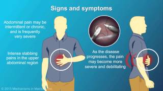 Chronic Pancreatitis [upl. by Brit770]