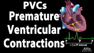 Premature Ventricular Contractions PVCs Animation [upl. by Ahsiened807]