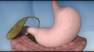 Gastric Sleeve Surgery Explained  Nuffield Health [upl. by Neeuq]