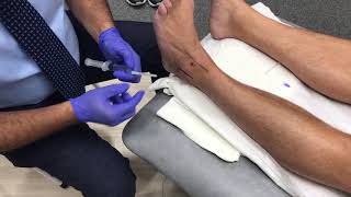 Ankle Steroid injection [upl. by Emanuel]