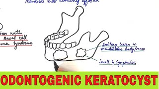 Odontogenic Keratocyst  Clinical Radiographic and Histopathologic Features [upl. by Fara923]