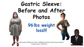 Gastric Sleeve Surgery Patient Experiences [upl. by Theo989]