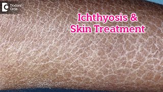 What is Ichthyosis How to Treat my Skin Fish like scales On SkinDrRasya Dixit  Doctors Circle [upl. by Nodanrb153]