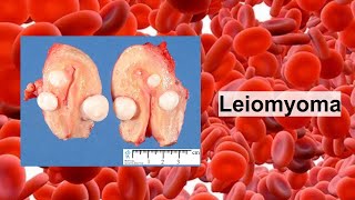 Oesophagus Leiomyoma [upl. by Assiron]